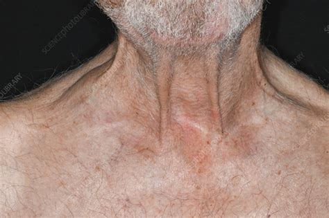 Lump Above Mans Clavicle Due To Lymphoma Stock Image C0585522