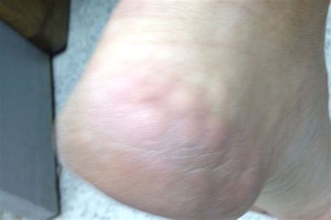 Clinical Challenge White Lumps On Heel When Standing Mpr