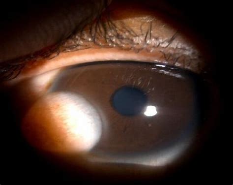 A Presence Of Left Eye Inferonasal Limbal Dermoid B Post Limbal