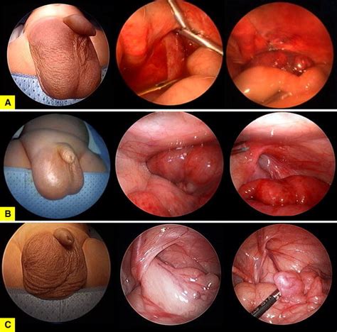 Incarcerated Inguinal Hernia In Male Pediatric Patients A Ischemia