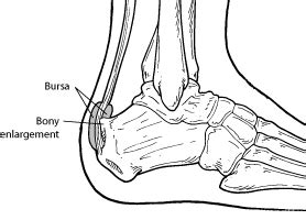 Haglund Foot Deformity Specialist Singapore Sports And Orthopaedic