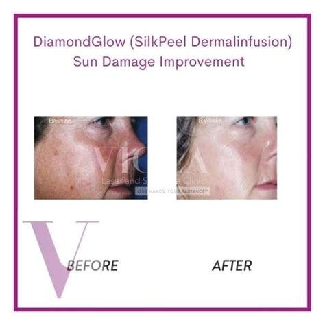 Diamondglow Silkpeel Dermalinfusion Facial Viola Laser And Skin Care
