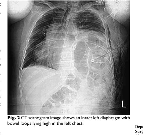 Pdf Congenital Diaphragmatic Eventration In An Adult A Diagnostic