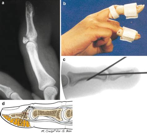 Hand And Wrist Tendinopathies Musculoskeletal Key