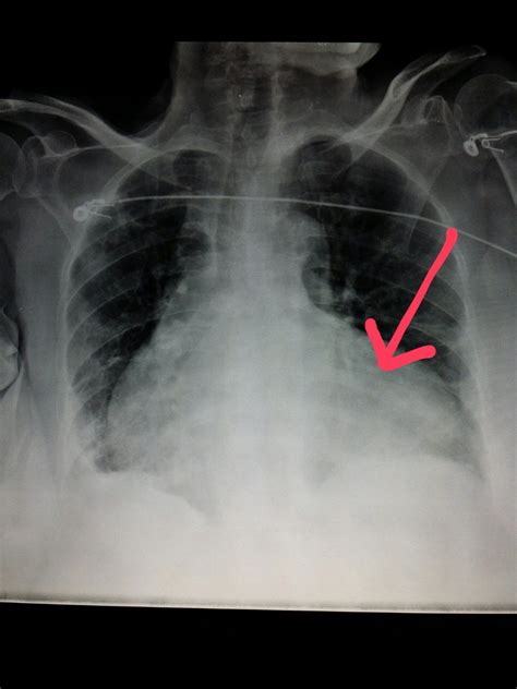 Congestive Heart Failure X Ray