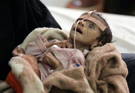The Tragic Story Of A Dead Baby Shows The Terrible Toll Of Yemens War