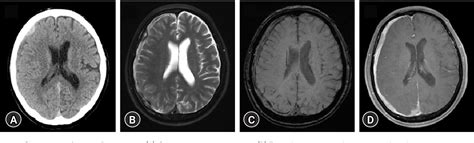 Figure 2 From A Rare Case Of Hypertrophic Pachymeningitis After Surgery
