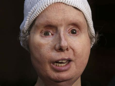 Woman Disfigured In Chimpanzee Attack Seeks Right To Sue The State Of