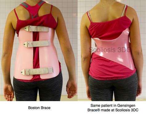 How To Get Fitted For A Scoliosis Brace Brandon Orthopedics
