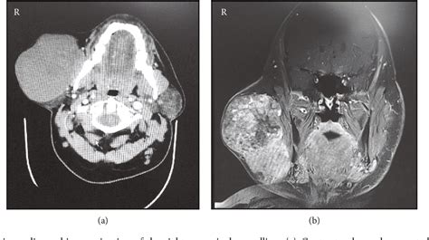 Figure 2 From Giant Parotid Pleomorphic Adenoma With Atypical