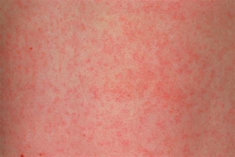 German Measles Rubella Rash On Skin Of A Child