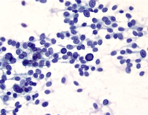 Papanicolaou Society Of Cytopathology Case Of The Month April 2016