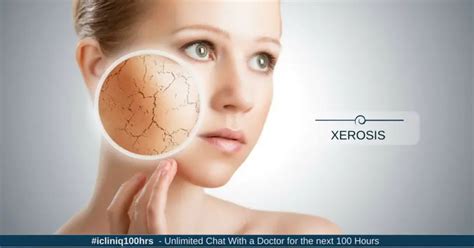 Xerosis Dry Skin How To Get Rid Of It