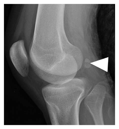 Lateral Plain Film Of The Left Knee Revealed A Transverse Radiolucent