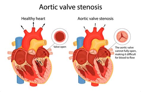 Aortic Stenosis Exploring A Critical Heart Condition Add More To Lives