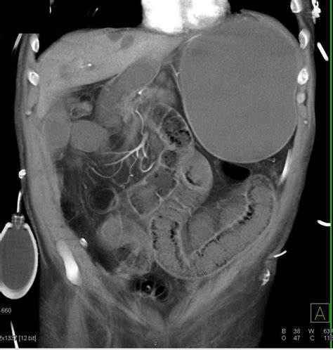 Small Bowel Obstruction Due To Adhesions Small Bowel Case Studies
