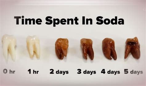 Maybe you would like to learn more about one of these? So what happens when you put a real tooth in soda for 5 ...