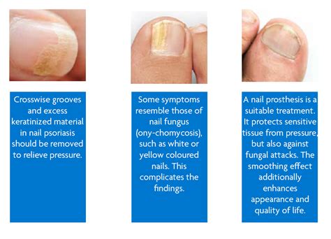 Psoriatic Nails Relieve The Patient Gehwol Footcare