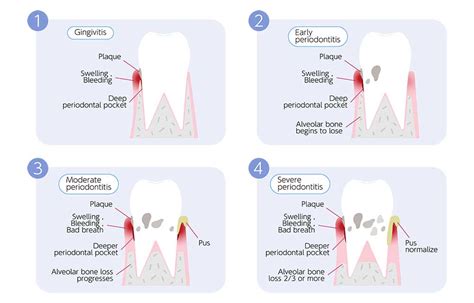 What Are The Stages Of Periodontal Disease Implant Perio Center
