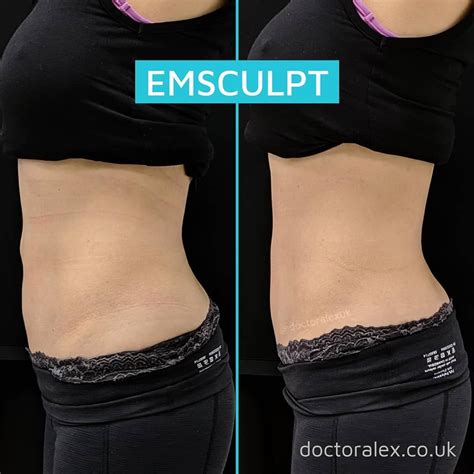 Body Sculpting Before And After One Session