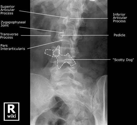 Lumbar Spine Radiographic Anatomy Wikiradiography