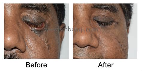 Cheekbone Fracture Surgery And Lower Eyelid Correction Cheekbone
