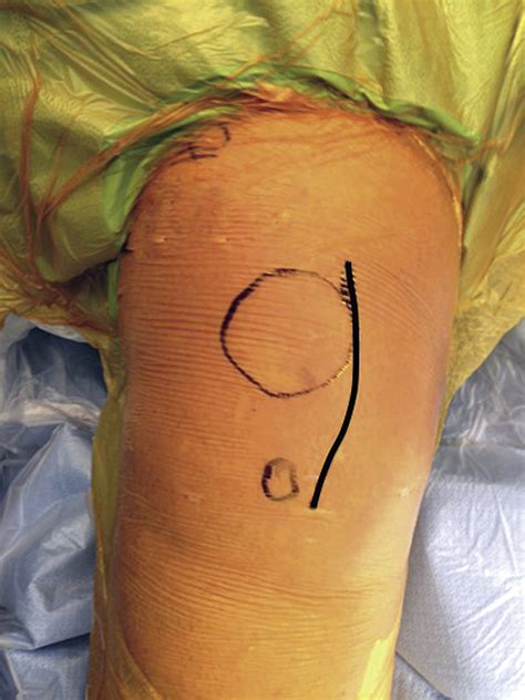 Total Knee Arthroplasty Via Small ­incision Midvastus Approach