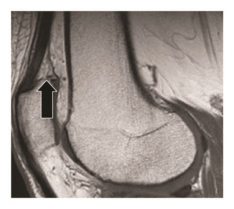 T1 Weighted Mr Images Showing Different Infrapatellar Fat Pad Ipfp