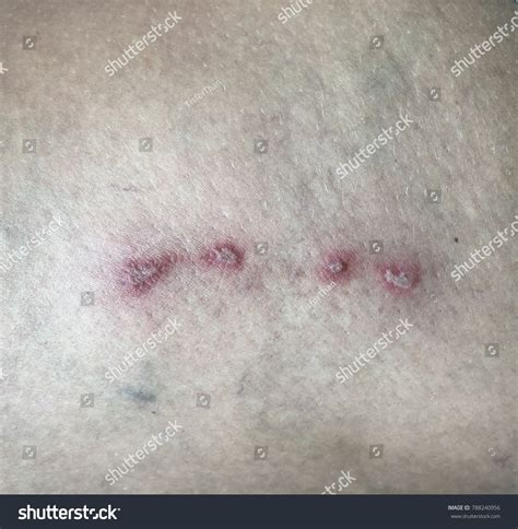 Multiple Erythematous Papule Right Thigh Contact Stock Photo 788240956