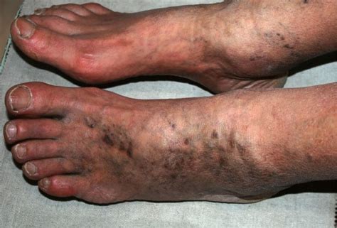 Chronic Venous Insufficiency Causes Symptoms And Treatments Mvs