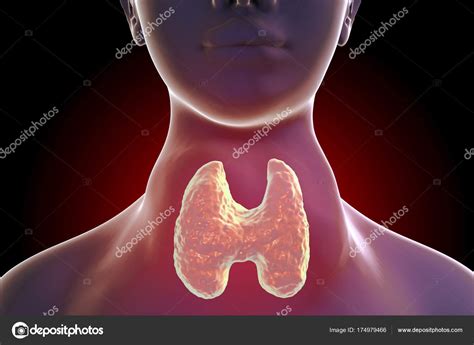 Toxic Diffuse Goiter Hyperthyroidism ⬇ Stock Photo Image By