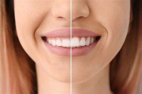 Gingivectomía Te Explicamos Todas Las Claves De Este Tratamiento