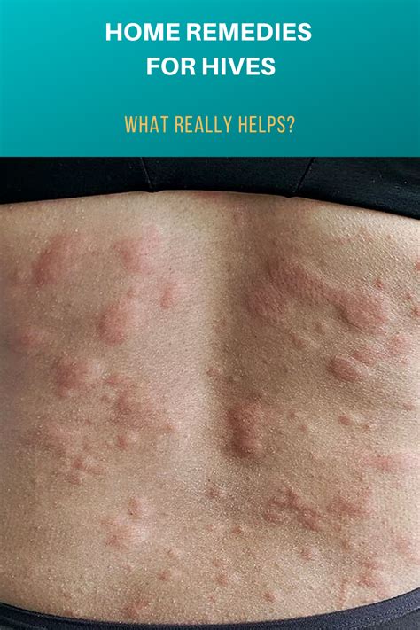 Home Remedies For Hives What Really Helps Home Remedies For Hives