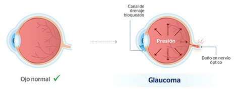 Glaucoma Ocular Qué Es Síntomas Y Causas Clínica Baviera