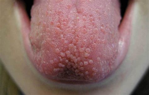 Lie Bumps Symptoms Causes And Treatment