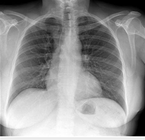 A Follow Up Chest X Ray Three Months After Surgery Shows Complete