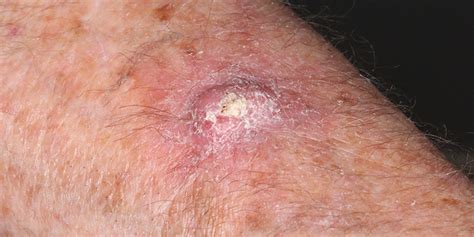Scc Keratoacanthoma Type Skin Cancer And Reconstructive Surgery Center