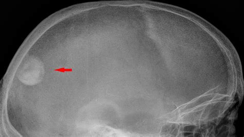 Dental X Rays Cause Brain Tumors Brain Tumors Dental Tumor