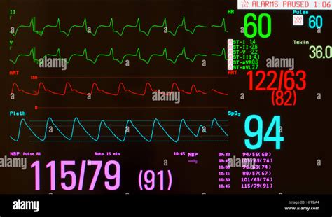 Monitor Showing Ecg With Paced Heart Rhythm Arterial Blood Pressure