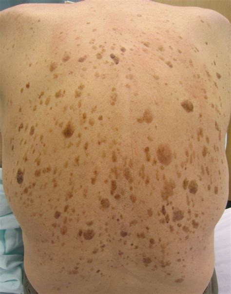 Dark Spots Symptoms And Causes