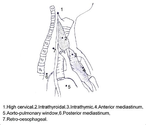 Ectopic Parathyroid Gland Locations Download Scientific Diagram