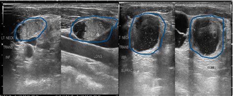 Thyroid Ultrasound 4 Things You Need To Know