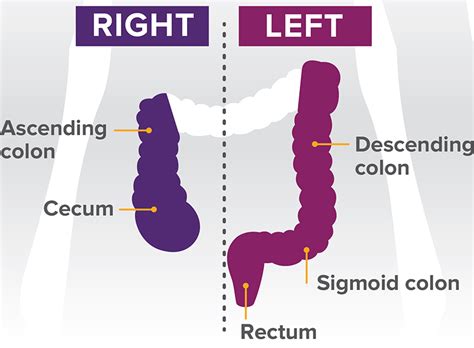 Right Vs Left Colon Cancer Symptoms Cancerwalls