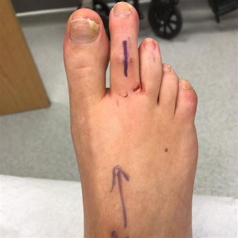 Toe Shortening Hammer Toe Surgery Leeds Yorkshire Foot