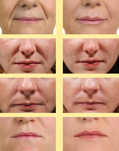 How To Get Rid Of Laugh Smile And Nasal Lines With Facial Workouts
