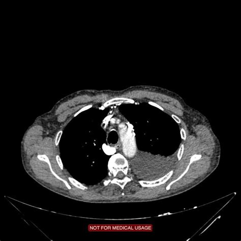 The advent of improved radiological imaging, and its more widespread availability for the superior vena cava is the major route for venous return to the heart from the head, arms, and upper torso. Superior vena cava obstruction | Radiology Case ...