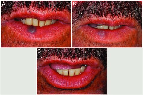 Male Patient 56 Years Old With A Congenital Lesion In The Lower Lip