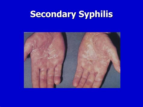 Ppt Syphilis Clinical Aspects Of Secondary Syphilis Powerpoint