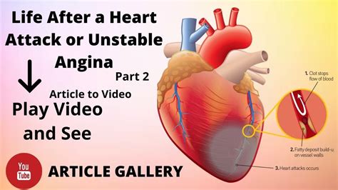 Life After A Heart Attack Or Unstable Angina Part 2 Article