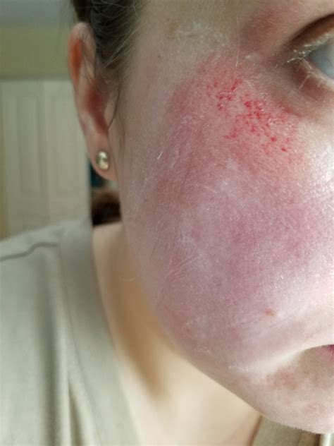 Skin Concerns Rug Burn On Face How Best To Treat It R